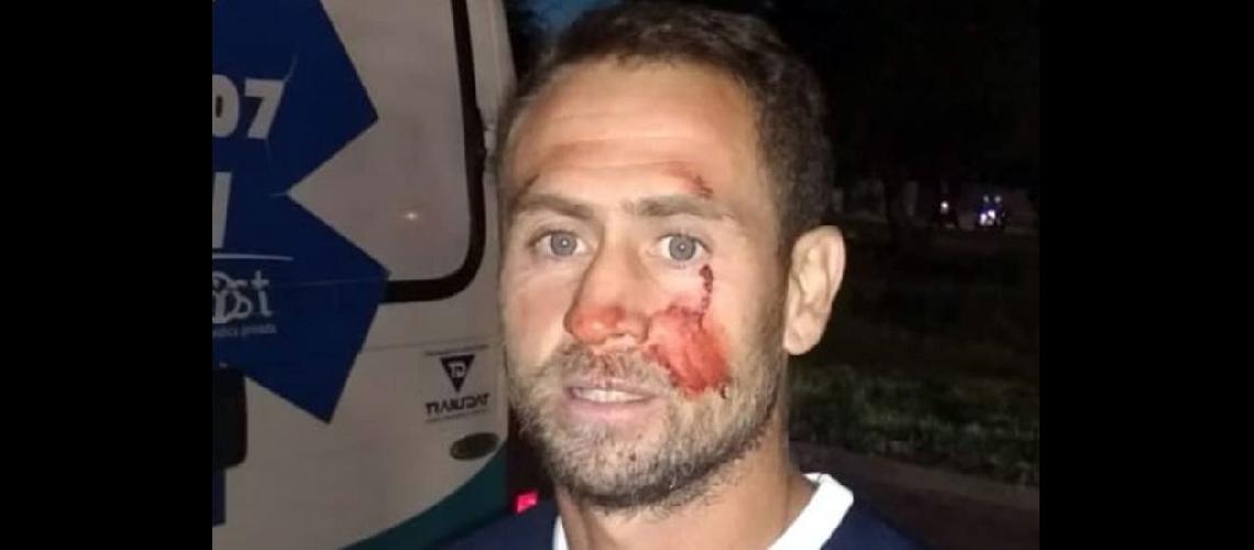  El delantero Gabriel Bibi Gonzlez y la secuelas en su rostro tras la agresión recibida (PEÑAROL DE SAN JUAN)