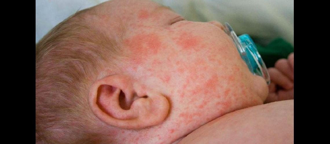  Confirmaron la semana pasada tres nuevos casos de sarampión en dos niñas de 11 meses y una niña de 3 años (PERFIL)
